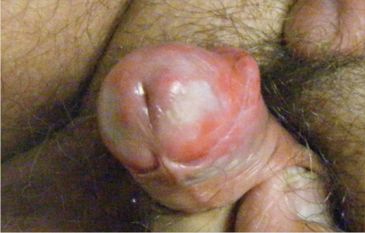 1. En 63-årig man klagar över ett lindrigt smärtsamt och ömt utslag på sin penis som har funnits där i nästan två år. Patienten är oomskuren; när förhuden dras tillbaka syns ett ljusrött, erythematöst, icke-skalkigt, cirkumferentiellt plack på glanspenisen som sprider sig till förhuden. Han förnekar smärta vid urinering, flytningar, feber, illamående, artralgi och sexuell kontakt utanför äktenskapet bild
