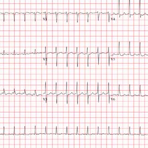 ECG