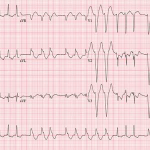 ECG