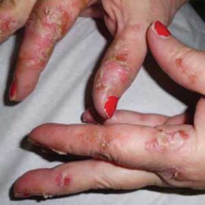 Palmar erythematous scaly plaques with scattered pustules