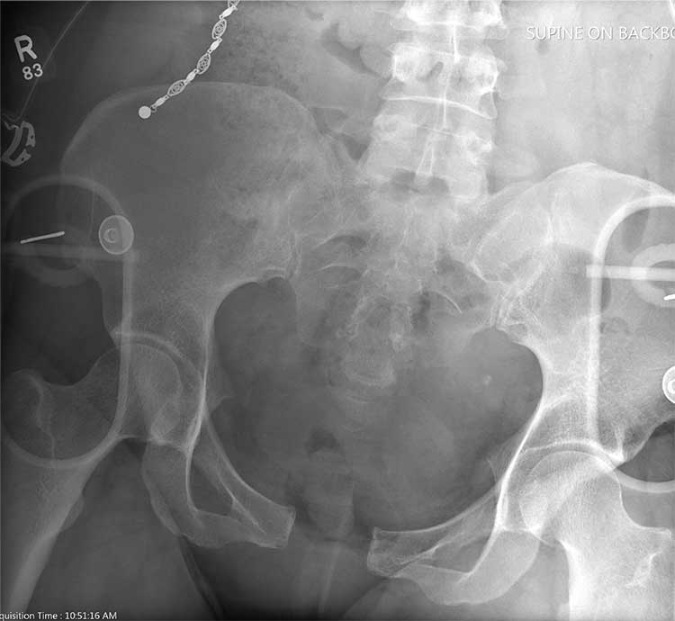 Pelvis radiograph