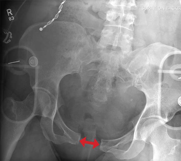 Radiograph of openbook pelvic fracture