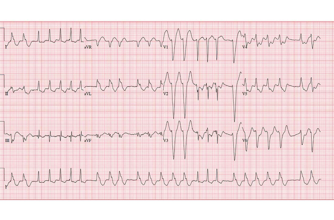 ECG