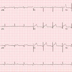 Electrocardiogram