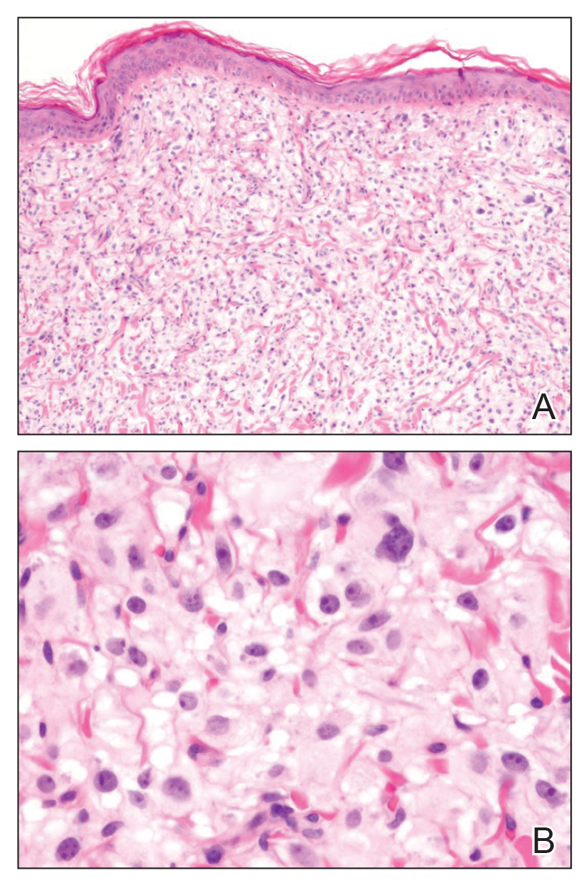 Pruritic Nodules on the Breast