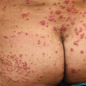 Testosterone pellet–induced dermatitis before treatment