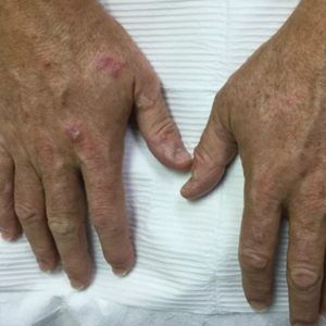 Hypertrophic Lichen Planus–like Eruption Following Pembrolizumab