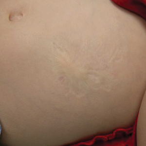 Atrophic Lesion on the Abdomen