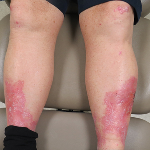 Erythema, Blisters, and Scars on the Elbows, Knees, and Legs