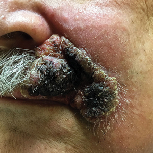 Expanding Verrucous Plaque on the Face 