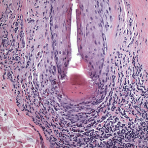 Hair Follicle Bulb Region: A Potential Nidus for the Formation of Osteoma Cutis