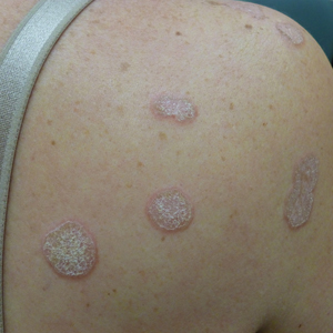 Hyperkeratotic Nummular Plaques on the Upper Trunk