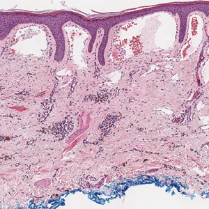 Violaceous Papule With an Erythematous Rim