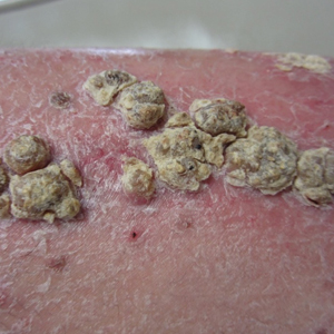 Unilateral Verrucous Psoriasis