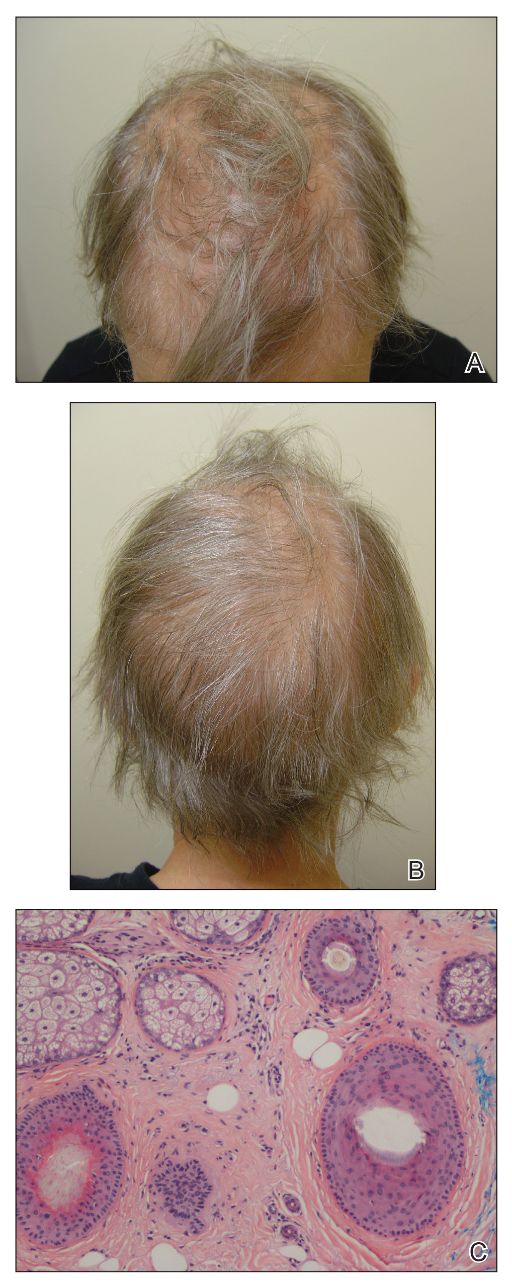 Permanent Alopecia in Breast Cancer Patients: Role of Taxanes and Endocrine  Therapies | MDedge Dermatology