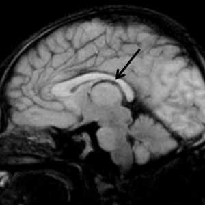 Incontinentia Pigmenti: Initial Presentation of Encephalopathy and Seizures 