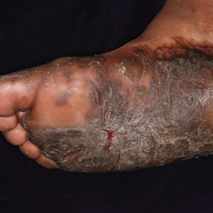 Thick Hyperkeratotic Plaques on the Palms and Soles