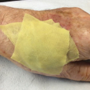 24-7 Dressing Technique to Optimize Wound Healing After Mohs Micrographic Surgery