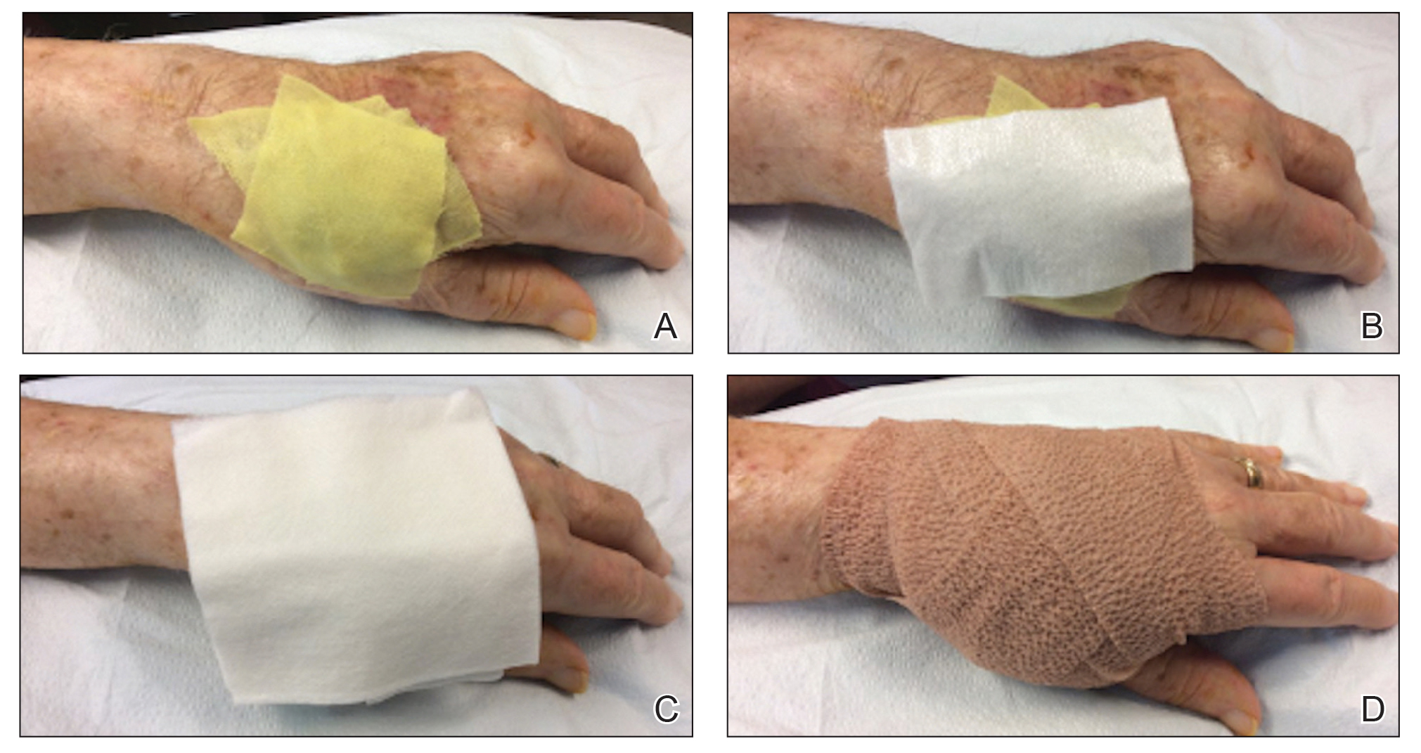 Dressing Technique To Optimize Wound Healing After Mohs