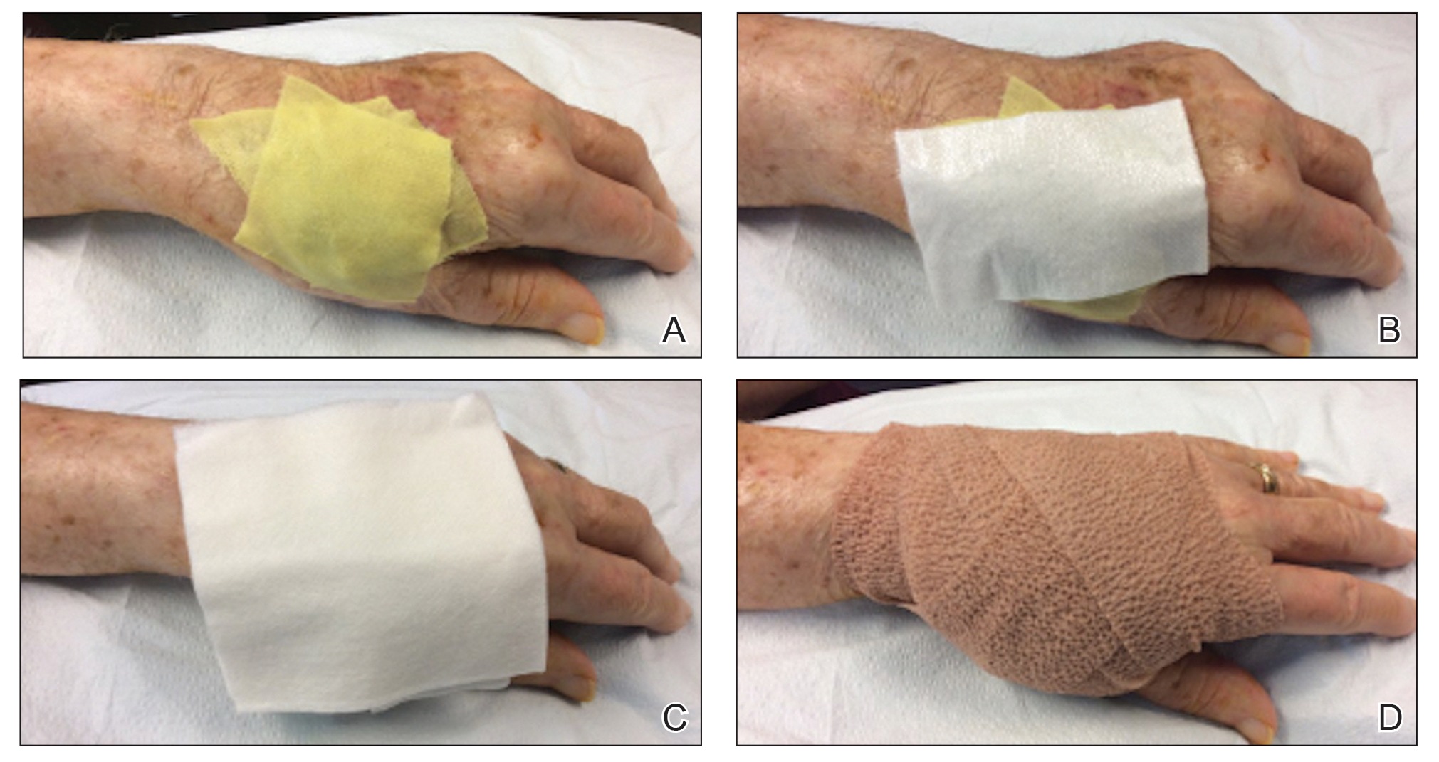 24 7 Dressing Technique To Optimize Wound Healing After Mohs 