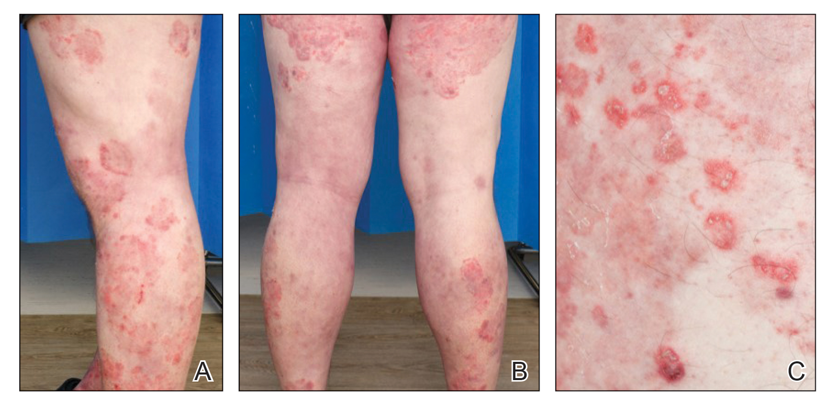 Widespread red annular plaques on the legs