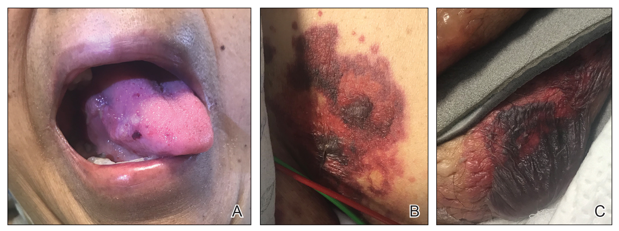 FIGURE 2. Bullous amyloidosis. A, Localized hemorrhagic bulla on the lateral tongue. B and C, Large hemorrhagic bullae on the groin. 