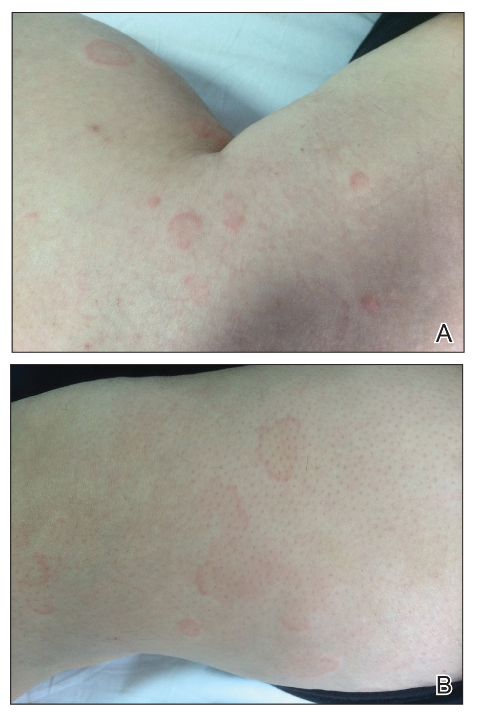 Erythematous and edematous annular papules and plaques on the arms and legs, respectively