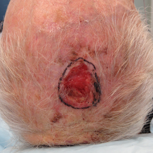 Squamoid Eccrine Ductal Carcinoma