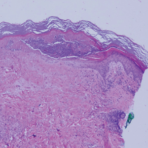 Atrophic Lesions in a Pregnant Woman