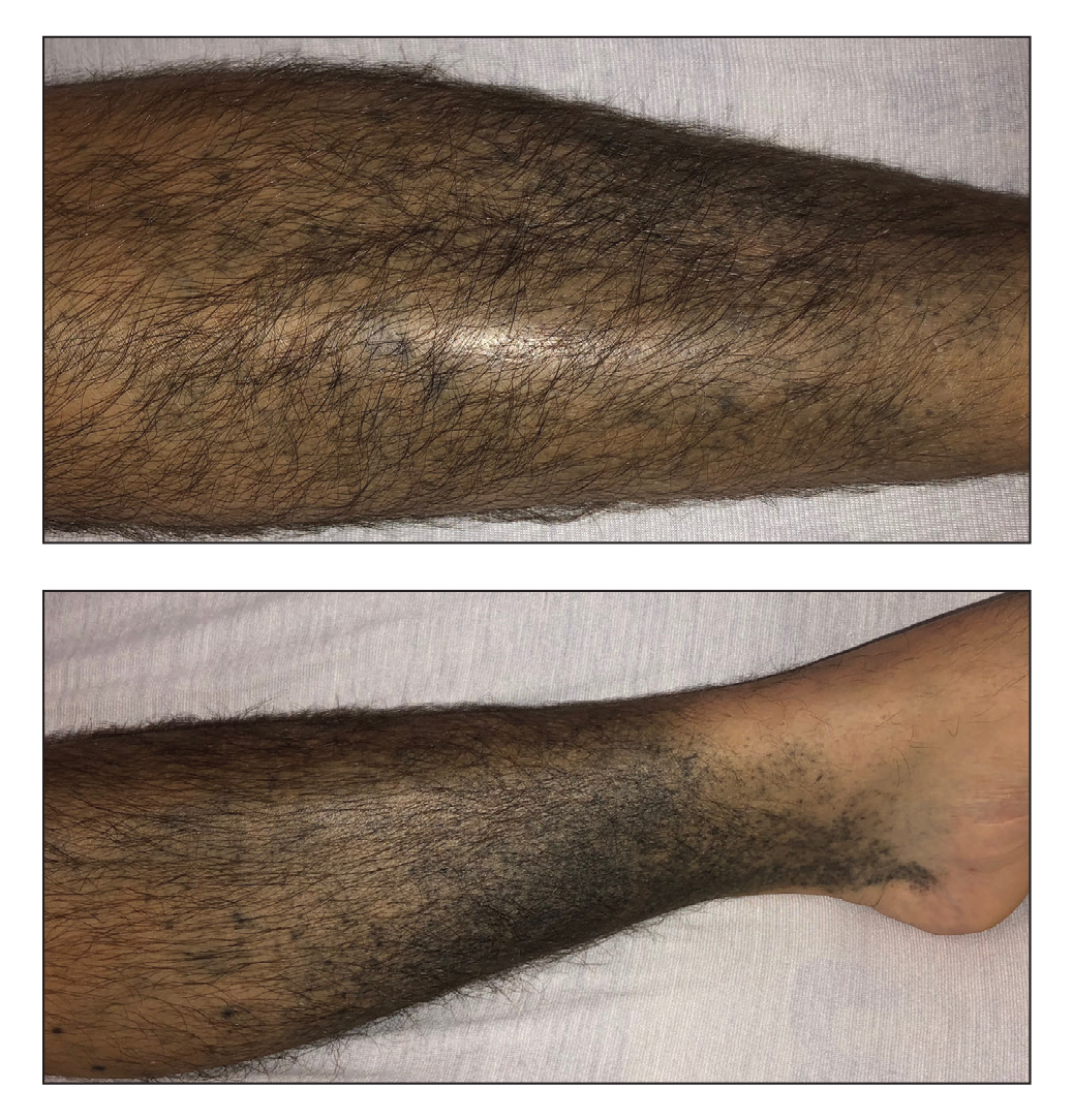 Chronic Hyperpigmented Patches on the Legs
