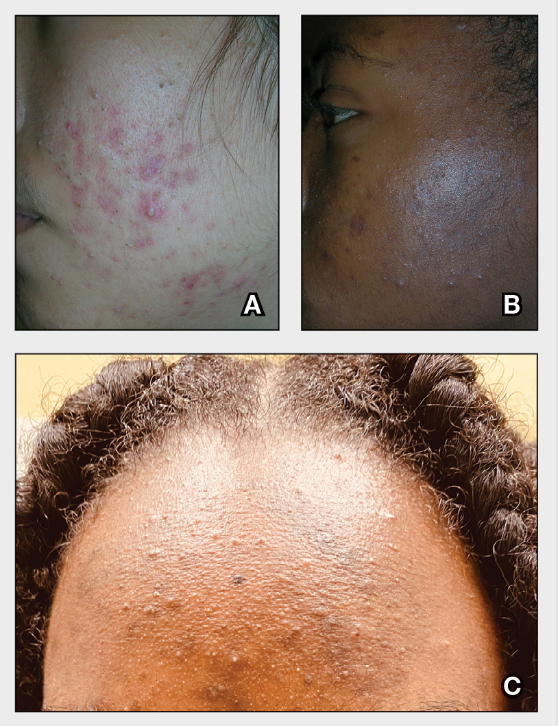 Acne Vulgaris MDedge Dermatology