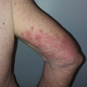 Herpes zoster with localized, fluid-filled vesicles on the internal and posterior aspects of the right arm