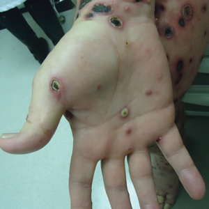 Febrile ulceronecrotic Mucha-Habermann disease. Ulcerative and crusted violaceous papules on the right palm