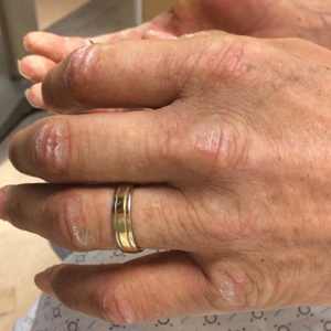 Bound-down, indurated, fissured plaques most prominent on the hands in a patient with nephrogenic systemic fibrosis.