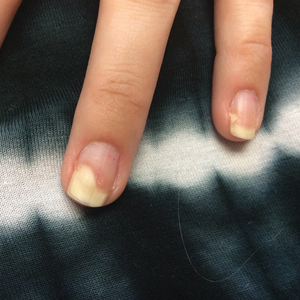 Severe acute onycholysis noted on the fourth and fifth fingernails of the left hand after ixekizumab injections for psoriasis and psoriatic arthritis.