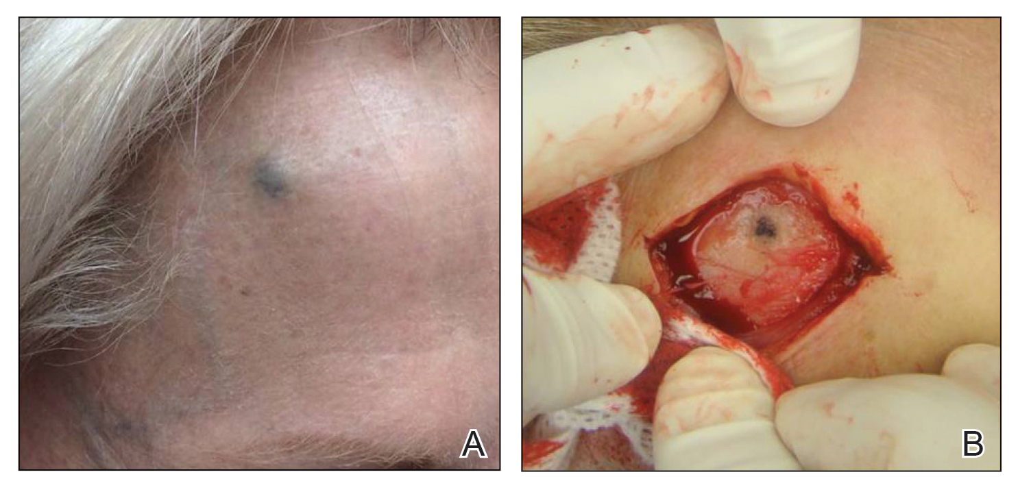  A, A 1.0-cm, round, bluish-black nodule on the right superior forehead. B, Intraoperative view of pigment extending into the underlying frontal bone.