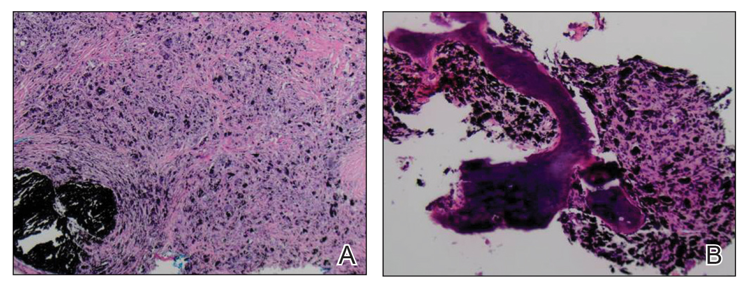 A, Low-power view demonstrated a granulomatous dermatitis with abundant pigment. Numerous foreign body–type giant cells and fibrosis were associated with the pigment (H&E, original magnification ×40).