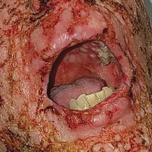 Desquamation and erosions involving the face as well as the oral and nasal mucosae 