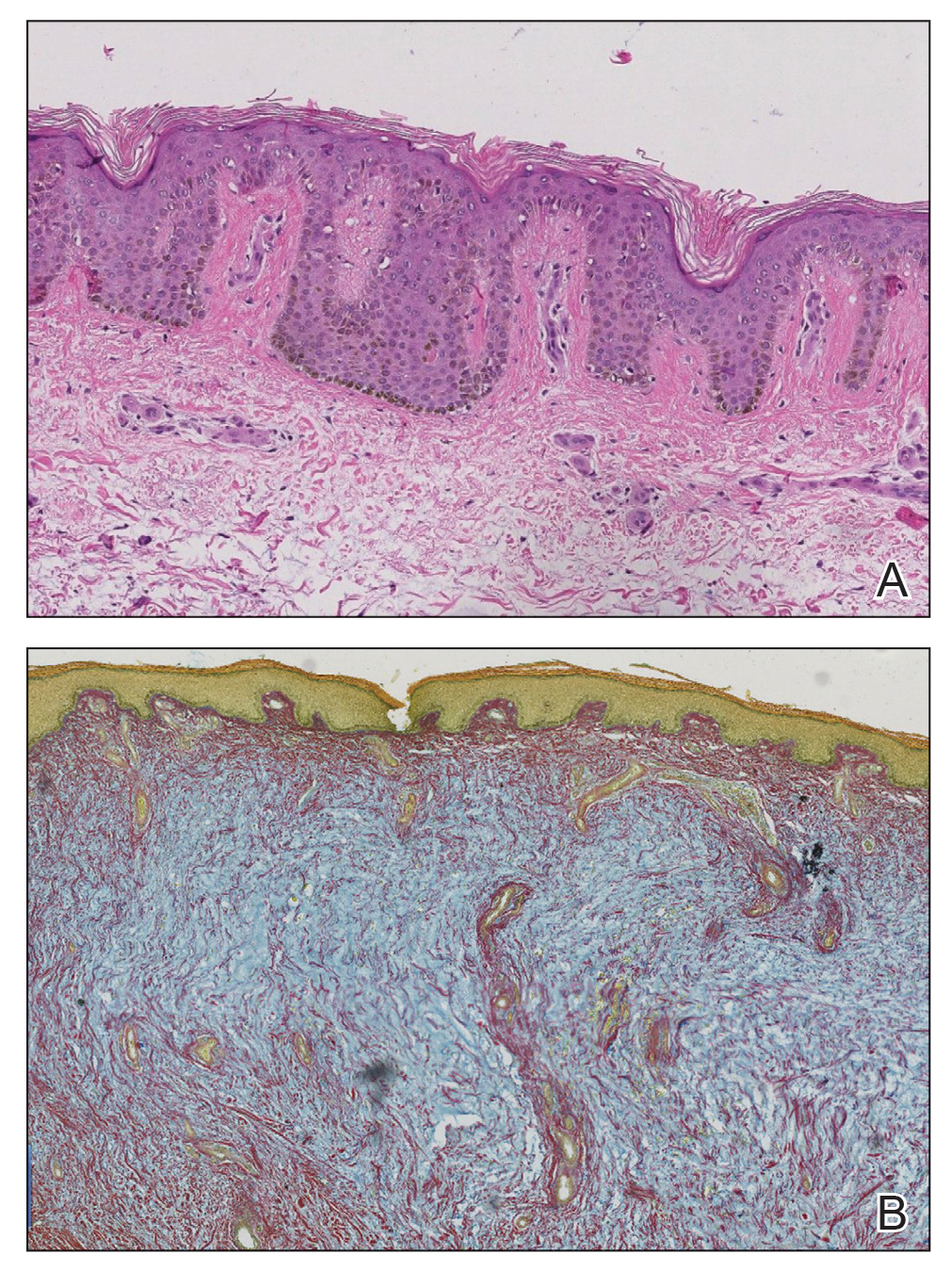 A, A biopsy of the left posterior calf showed marked mucin deposition in the superficial and deep dermis with deep fibroplasia (H&E). B, Colloidal iron staining highlighted the prominent mucin within the dermis