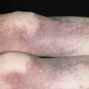 Nonpalpable purpura on the lower limbs