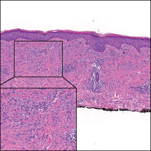 H&E, original magnification ×40 (inset, original magnification ×200).