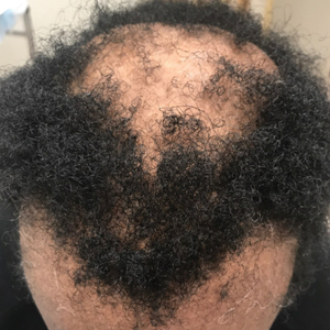  Central centrifugal cicatricial alopecia presenting as a shiny smooth patch of hair loss over the vertex of the scalp