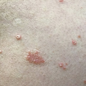 Guttate psoriasis that manifested as erythematous, silvery, scaly papules 3 weeks after COVID-19 infection