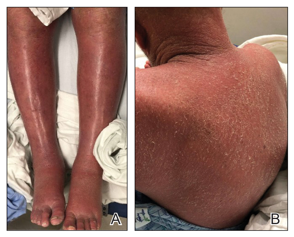 A psoriasis patient who was treated with secukinumab later developed atopic dermatitis.