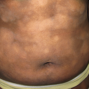 A female with FST V and MF (stage IB) who presented with hypopigmented scaly patches on the abdomen