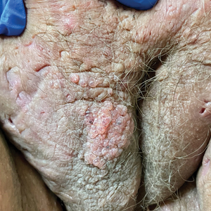 Chronic vulvar plaque