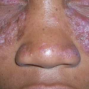 Multicolored (pink, brown, and white) indurated plaques in a butterfly distribution on the face of a 30-year-old woman with a darker skin tone