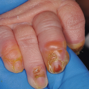 Blistering lesions in a newborn