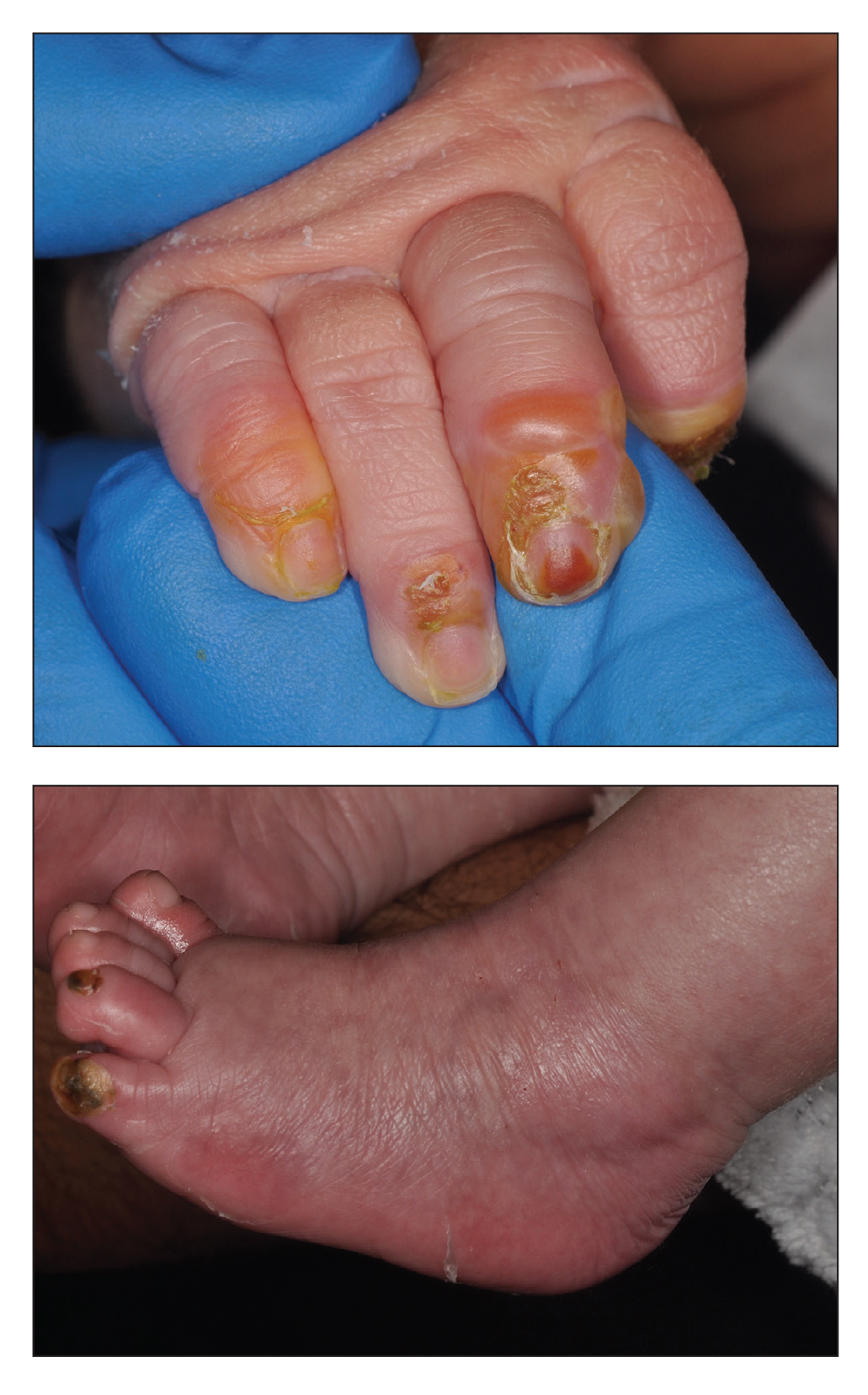 Blistering lesions in a newborn