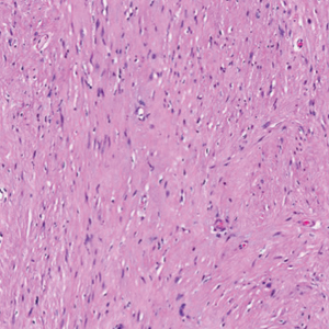 Histopathology of a fully encapsulated schwannoma with cystic areas and hemorrhagic areas 